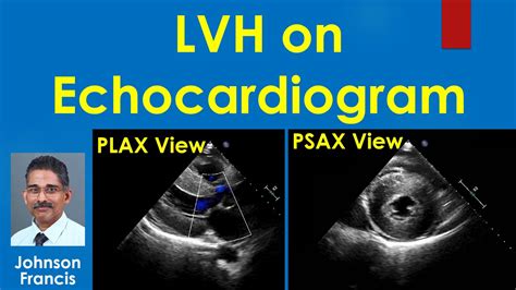 mild lvh on echo